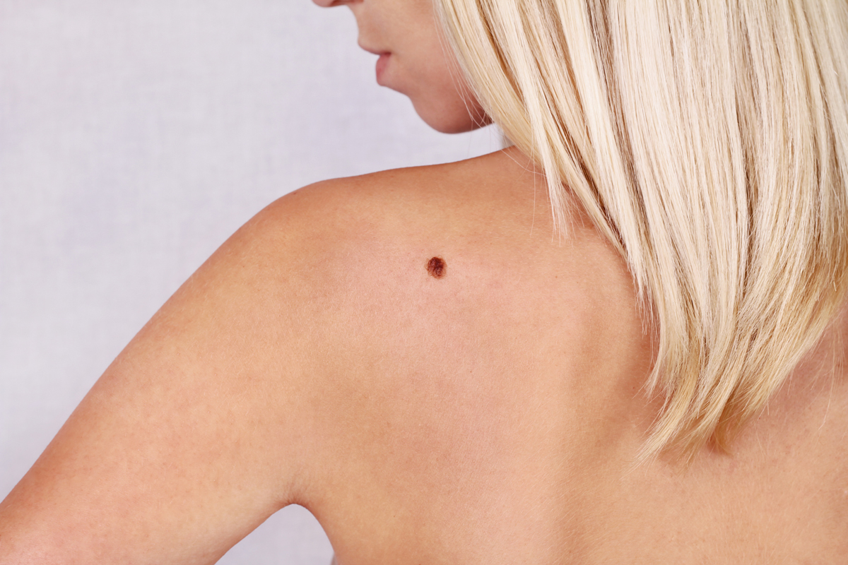 Comment diagnostiquer le cancer de la peau ?